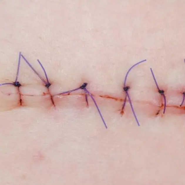 Sutures